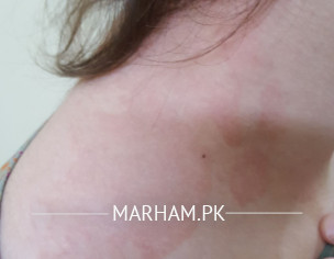 Skin Problem