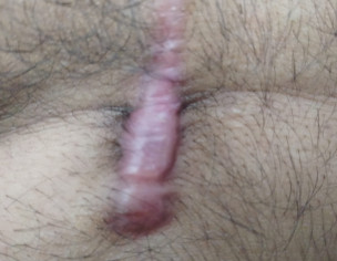 Cardic Surgery