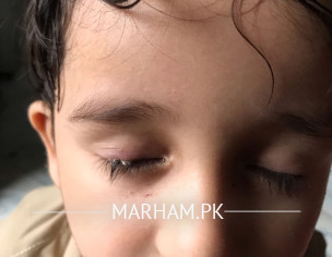 Eyelid Allergy