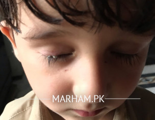 Eyelid Allergy