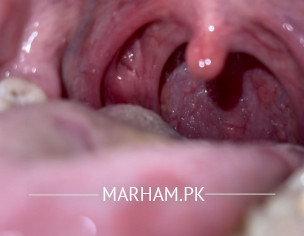 ENT THROAT Problem