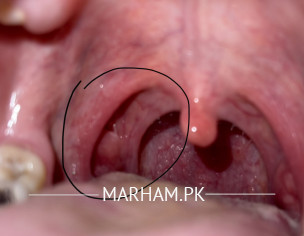 ENT THROAT Problem