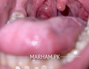 ENT THROAT Problem