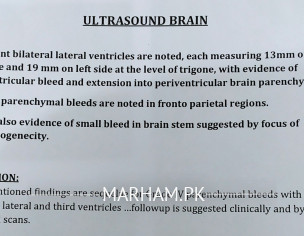 Brain Bleed