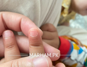 Dark Line On Nail