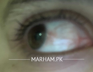 Eye Problem