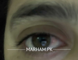 Eye Problem