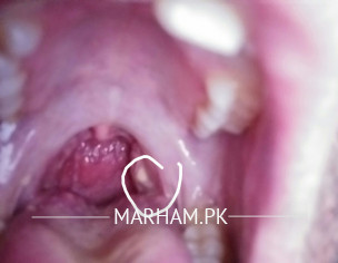 Tonsils Stone
