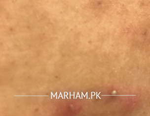 Acne Like Bump With Black Something Inside