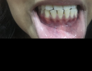 Dental Problem