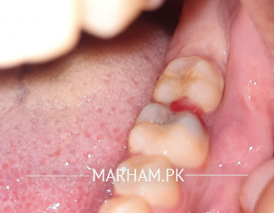 Teeth Pain
