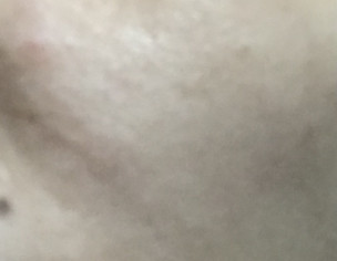 Face Bumps
