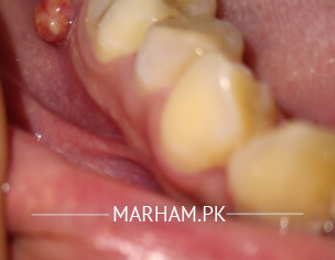 Teeth Problem