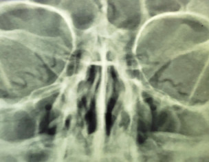 Sinusitis, Headache