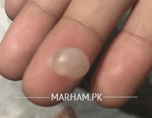 Finger Burnt