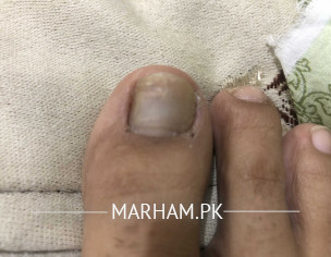 Blacken Toe Nail 