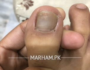 Blacken Toe Nail 