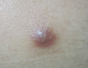 Pimple On Back