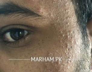 Acne And Spots 
