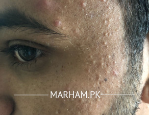 Acne And Spots 