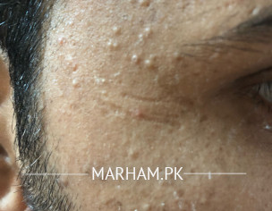 Acne And Spots 