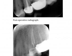 Dental Pain