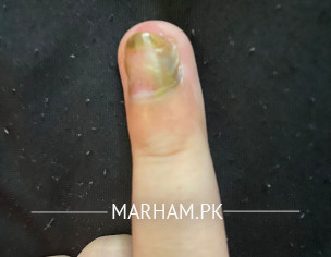 Infected Nail