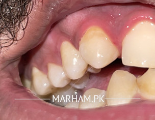 Teeth Gums