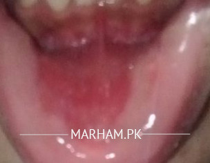 Lower Lip Inside Redness (red Patch)