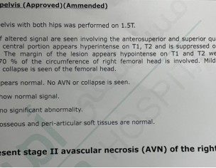 Right Hip Pain