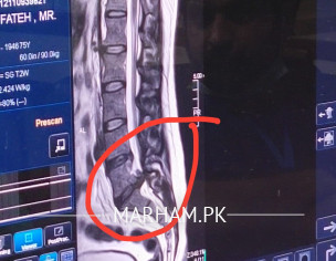 Sciatica Detected