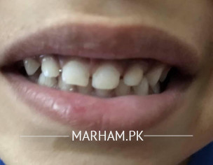 Teeth Discolouration 