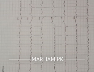 Heart Prb