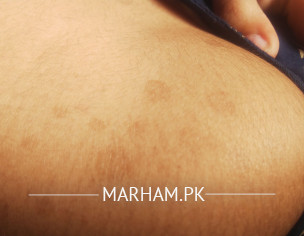 Skin Problem