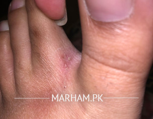 Eczema-pregnancy 