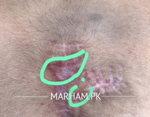 Spinal Cord Post Surgical Issue