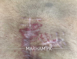 Spinal Cord Post Surgical Issue