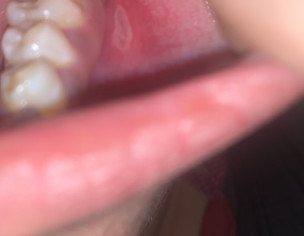 Mouth Sore