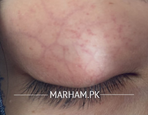 Skin Redspots