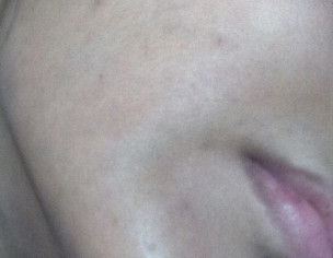 Acne Marks