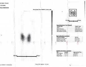 Hypothyroidism