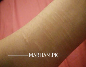 Cut Marks On Arm