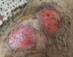 Accident Wound