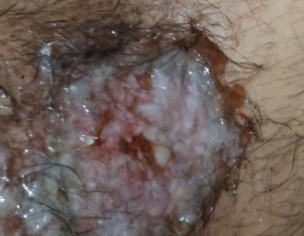 Accident Wound