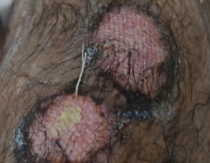 Accident Wound
