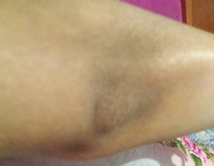 Dark Elbows