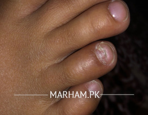 Hard Scratchy Nail  