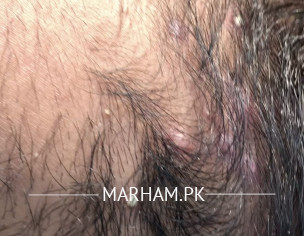 Rash At Neck Back