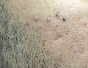 Acne Black Dot