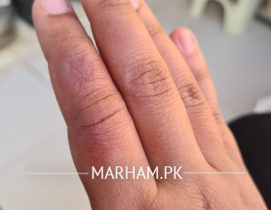 Burnt Finger